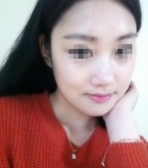 打肉毒素 大臉妹變小臉氣質(zhì)美眉 - 珍美網(wǎng)