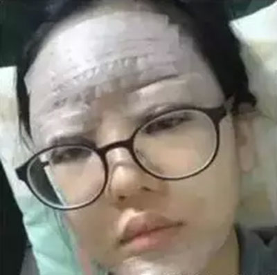 自體脂肪面部填充 精致做個(gè)氣質(zhì)美女 - 珍美網(wǎng)