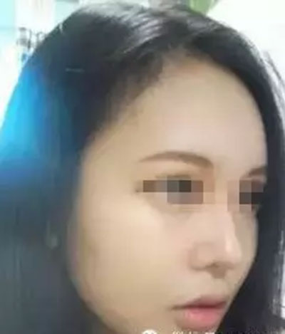 自體脂肪面部填充 精致做個氣質美女