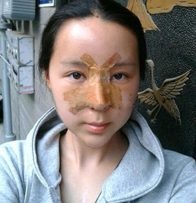 埋線法雙眼皮+硅膠隆鼻 把自己變得完美 - 珍美網