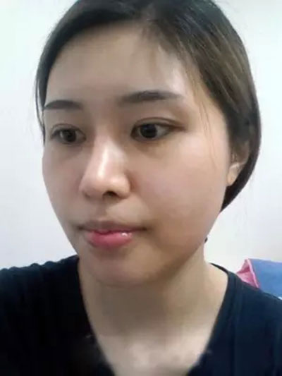 面部整形 從漢子變女神 - 珍美網(wǎng)