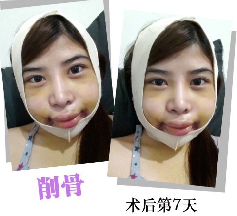 削骨整形 逆襲成回頭率百分百 - 珍美網(wǎng)