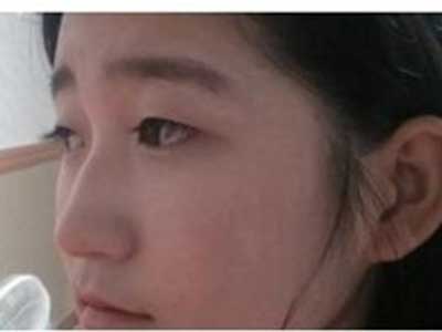 駝峰鼻和雙眼皮手術(shù) 因此變得更加耀眼 - 珍美網(wǎng)