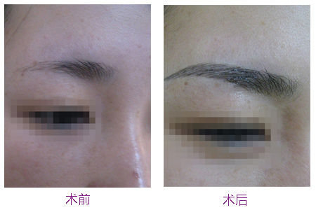 繡眉手術(shù)不適人群有哪些?