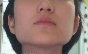 棱角下巴矯正+前顴骨磨骨 實現(xiàn)完美的臉蛋 - 珍美網(wǎng)