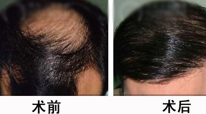 武漢碧蓮盛整形醫(yī)院頭發(fā)種植的價(jià)格是多少呢 - 珍美網(wǎng)