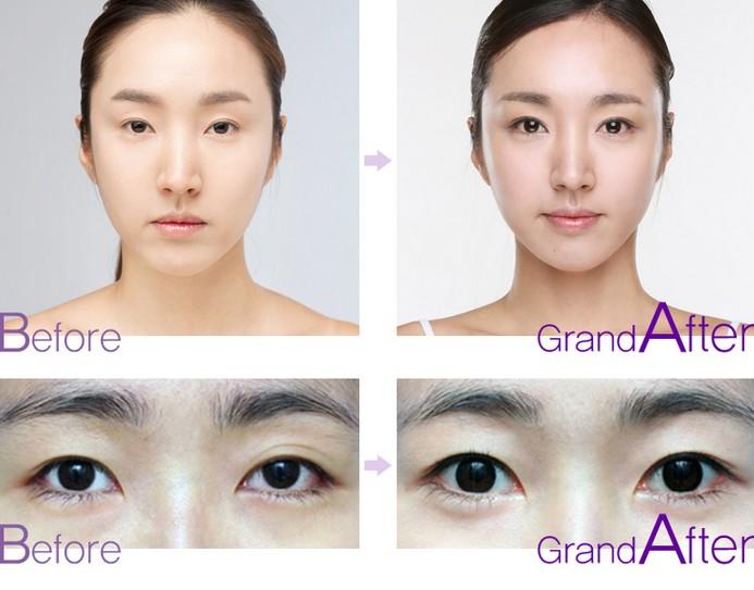 武漢美亞整形醫(yī)院開眼角費(fèi)用是多少呢 - 珍美網(wǎng)