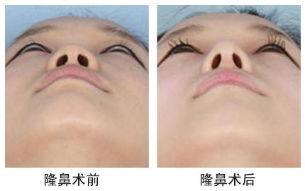 大連新華整形醫(yī)院膨體隆鼻手術價格是多少 - 珍美網(wǎng)