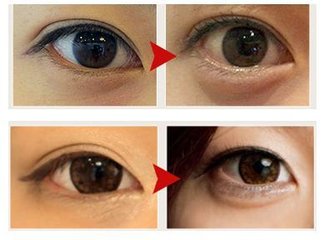 徐靖宏臥蠶手術(shù)價(jià)格多少錢 - 珍美網(wǎng)
