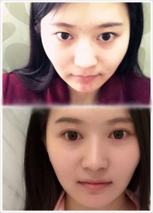 眼部整形 讓五官更加清晰美麗 - 珍美網(wǎng)