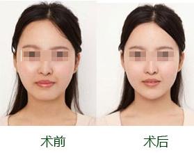 李長江隆下巴的價格多少錢呢 - 珍美網