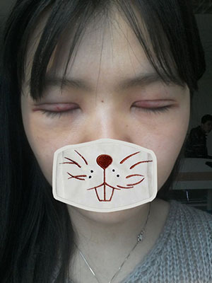 雙眼皮手術 實現(xiàn)閃亮的大眼睛 - 珍美網(wǎng)