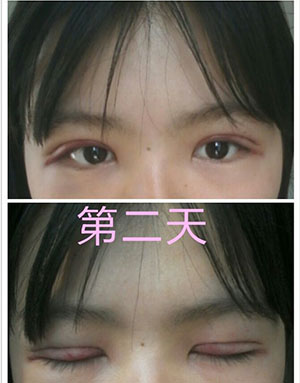 雙眼皮手術 實現(xiàn)閃亮的大眼睛 - 珍美網(wǎng)
