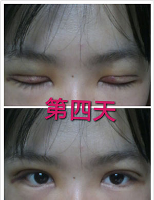 雙眼皮手術 實現(xiàn)閃亮的大眼睛 - 珍美網(wǎng)