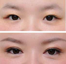 無(wú)錫春天整形醫(yī)院開(kāi)眼角手術(shù)費(fèi)用是多少 - 珍美網(wǎng)