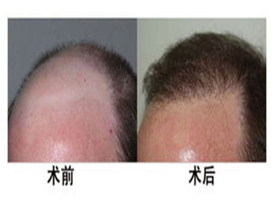 郭曄頭發(fā)種植價(jià)格多少錢 - 珍美網(wǎng)
