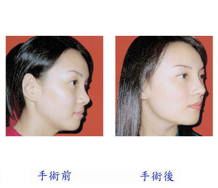 王軍隆鼻價格是多少 - 珍美網