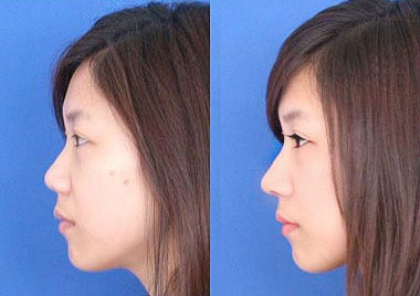 朱紅偉隆鼻價(jià)格是多少 - 珍美網(wǎng)
