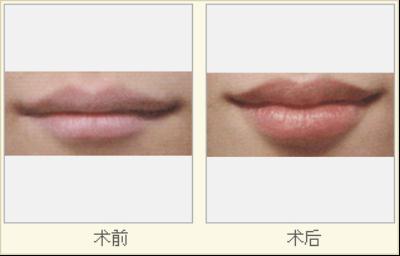 秦皇島巧致整形醫(yī)院口唇整形多少錢 - 珍美網(wǎng)