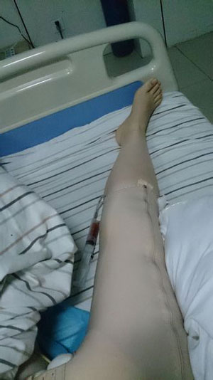 【大腿環(huán)吸+肉毒素瘦小腿】實(shí)現(xiàn)長腿美女不是夢 - 珍美網(wǎng)