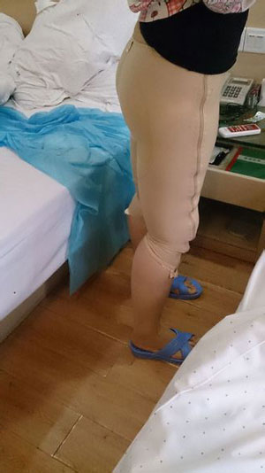 【大腿環(huán)吸+肉毒素瘦小腿】實(shí)現(xiàn)長腿美女不是夢 - 珍美網(wǎng)