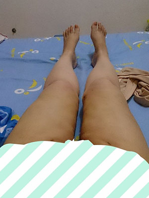 【大腿環(huán)吸+肉毒素瘦小腿】實(shí)現(xiàn)長腿美女不是夢 - 珍美網(wǎng)
