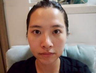 面部自體脂肪填充  還原最美的自己 - 珍美網(wǎng)