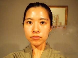 面部自體脂肪填充  還原最美的自己 - 珍美網(wǎng)