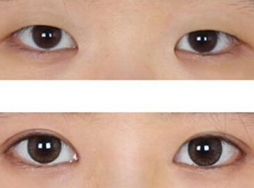 開內(nèi)眼角適用哪些人群