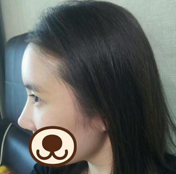 鼻部整形 變側(cè)顏氣質(zhì)美女