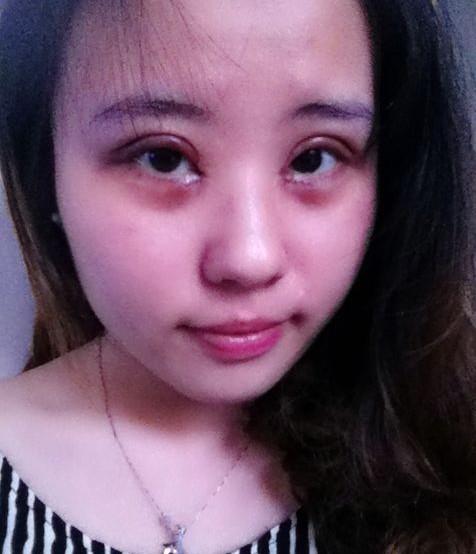 全切開內(nèi)眼角手術(shù) 讓自己越來越美麗 - 珍美網(wǎng)