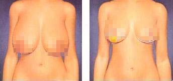 巨乳縮小手術(shù)效果如何