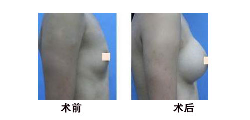 乳房再造的價格多少錢