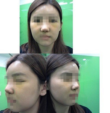 隆鼻整形  蹋鼻女王變高挺鼻女王 - 珍美網(wǎng)
