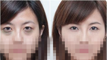 光子嫩膚去黑眼圈價格是多少