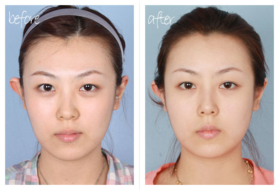 鼻尖成形術(shù)有哪些禁忌癥