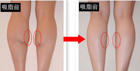 小腿吸脂費(fèi)用是多少