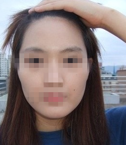 玻尿酸豐額頭 變側(cè)顏美女 - 珍美網(wǎng)