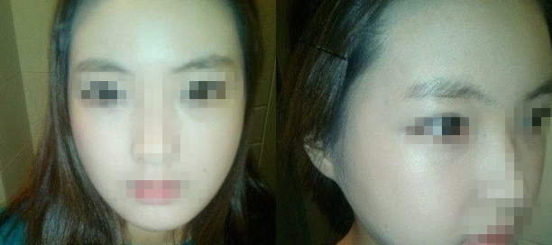 玻尿酸豐額頭 變側(cè)顏美女 - 珍美網(wǎng)