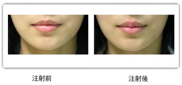 伊維蘭豐唇手術(shù)價(jià)格是多少