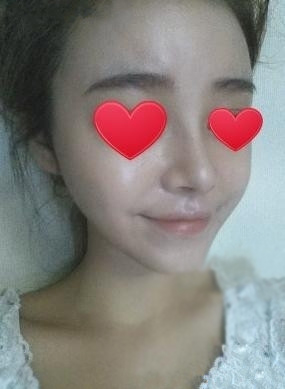 假體隆鼻 讓自己更加自信美麗 - 珍美網(wǎng)