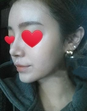 假體隆鼻 讓自己更加自信美麗 - 珍美網(wǎng)
