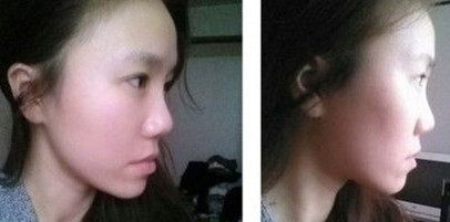 【臉部自體脂肪移植+鼻頭萎縮整形】 做自然美麗的女人 - 珍美網(wǎng)