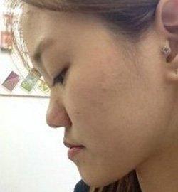 地包天矯正術(shù)  實現(xiàn)活潑美麗的自己 - 珍美網(wǎng)