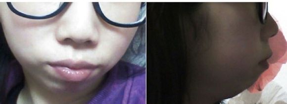 假體墊下巴 讓自己的側(cè)顏?zhàn)兊酶用滥?- 珍美網(wǎng)