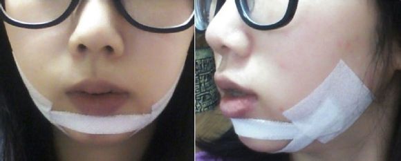 假體墊下巴 讓自己的側(cè)顏?zhàn)兊酶用滥?- 珍美網(wǎng)