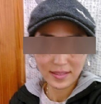 面部脂肪移植 讓自己變得更加自信美麗 - 珍美網(wǎng)