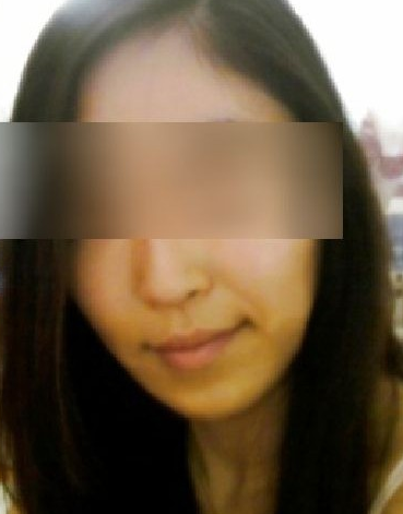 面部脂肪移植  讓自己變得更加自信美麗