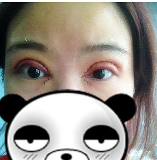 全切雙壓迫+開(kāi)眼角   擁有明亮又美麗的大眼美眉 - 珍美網(wǎng)