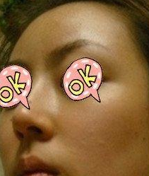 隆鼻手術(shù)  實(shí)現(xiàn)更美的自己